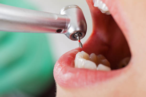 Best Lost Filling or Crown Replacement in Southport, NC